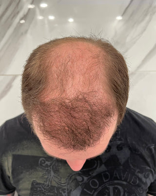 Before applying Elite Hair Fibers to thinning hair